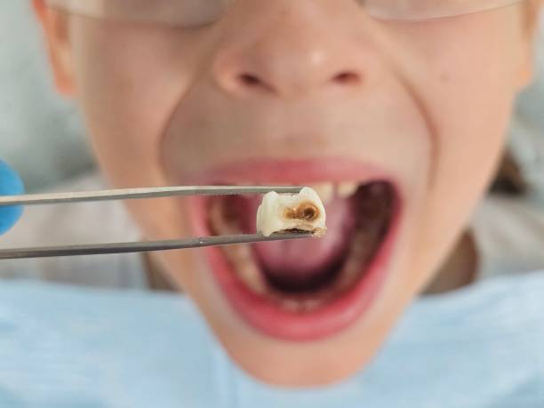 Best Knocked-Out Tooth Emergency  in Littlerock, CA